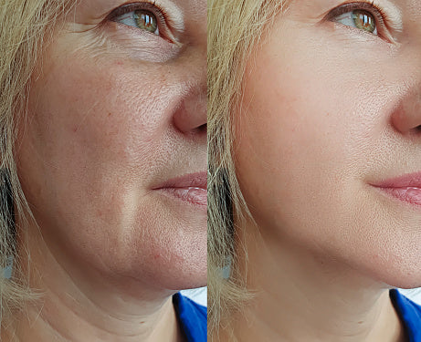 Derma Led mask™